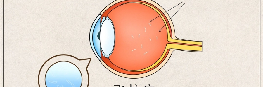 “蚊子”在眼里飛？這類人要注意了！